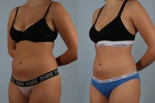 before and after coolsculpting left angle view female patient case 666
