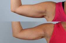 before and after coolsculpting right arm front view female patient case 673