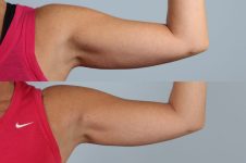 before and after coolsculpting left arm front view female patient case 673