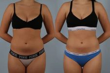 before and after CoolSculpting female patient front view case 666