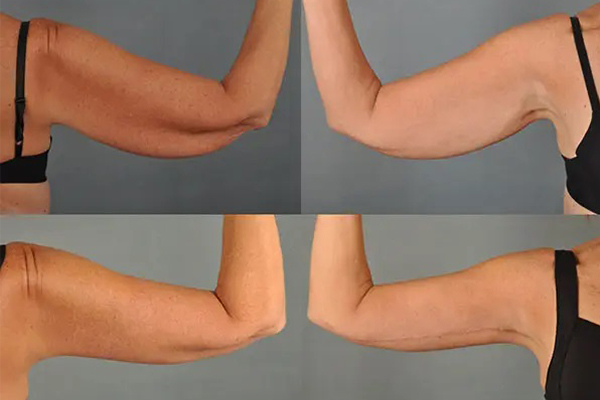before and after arm lift front and back view