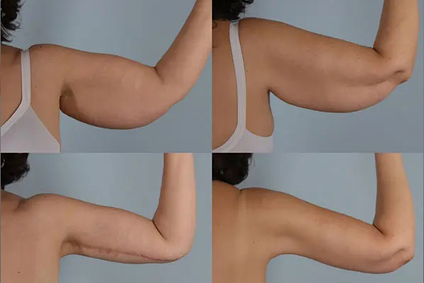 before and after arm lift front and back view