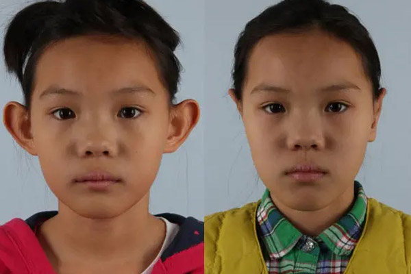 before and after otoplasty procedure front view