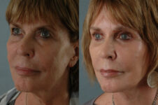 Before and After Eyelid Surgery Blepharoplasty Female Patient left angle view case 3466
