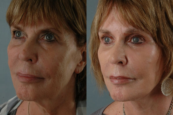 Before and After Eyelid Surgery Blepharoplasty Female Patient left angle view case 3466