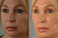 Before and After Eyelid Surgery Blepharoplasty Female Patient left angle view case 3470