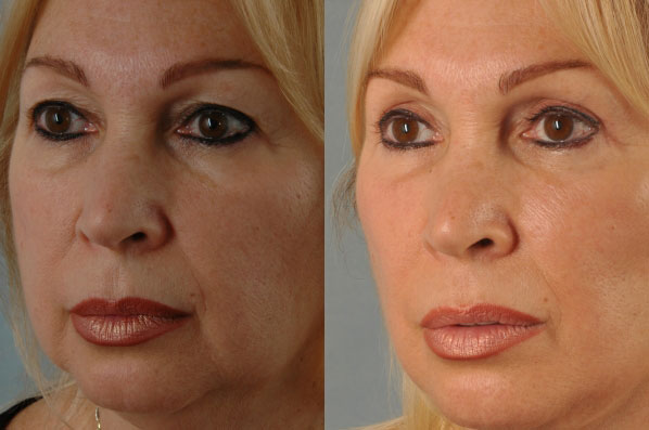 Before and After Eyelid Surgery Blepharoplasty Female Patient left angle view case 3470