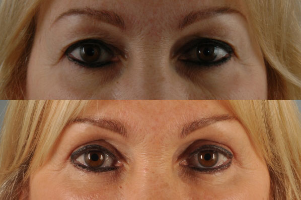 Before and After Eyelid Surgery Blepharoplasty Female Patient front view zoomed in case 3470