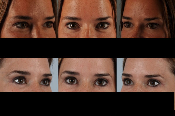 Before and After Eyelid Surgery Blepharoplasty Female Patient multiple angle view case 3478