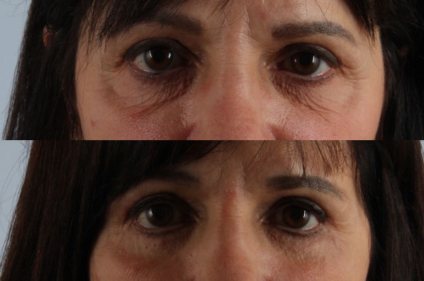 Before and After Eyelid Surgery Blepharoplasty Female Patient front view case 3481