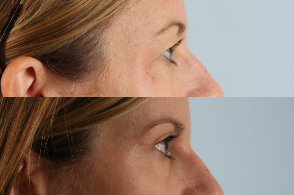 Before and After Eyelid Surgery Blepharoplasty Female Patient right side view case 3491
