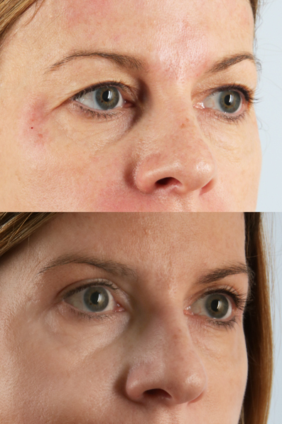 Before and After Eyelid Surgery Blepharoplasty Female Patient right angle view case 3491