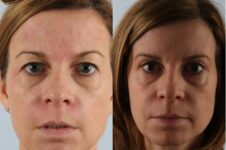 Before and After Eyelid Surgery Blepharoplasty Female Patient Front View Case 3491