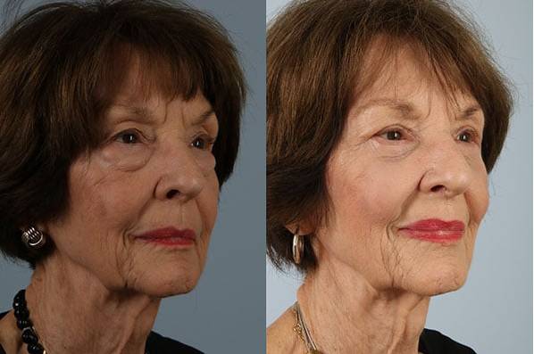 Before and After Eyelid Surgery Blepharoplasty Female Patient right angle view case 3501