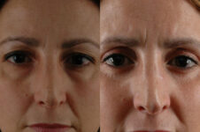Before and After Eyelid Surgery Blepharoplasty Female Patient front view zoomed in case 3508