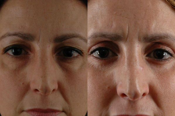 Before and After Eyelid Surgery Blepharoplasty Female Patient front view zoomed in case 3508