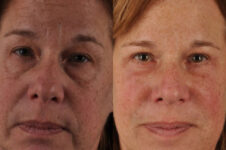 Before and After Eyelid Surgery Blepharoplasty Female Patient front view case 3528
