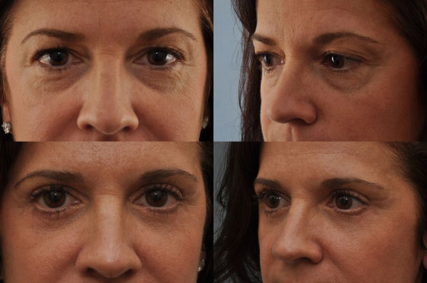 Before and After Eyelid Surgery Blepharoplasty Female Patient Front and left angle view case 3531