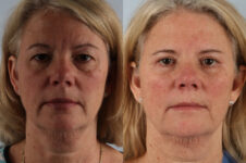 Before and After Eyelid Surgery Blepharoplasty Female Patient front view case 3535