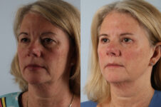 Before and After Eyelid Surgery Blepharoplasty Female Patient left angle view case 3535