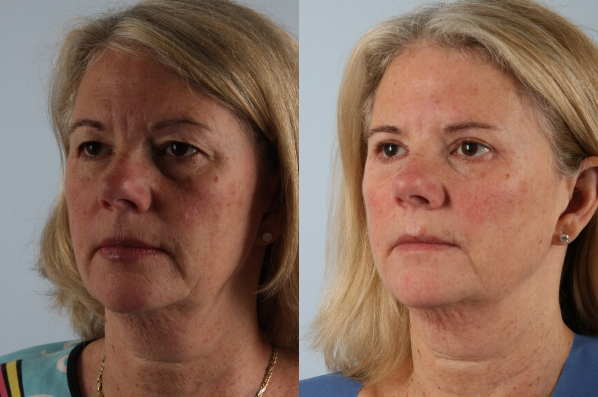 Before and After Eyelid Surgery Blepharoplasty Female Patient left angle view case 3535