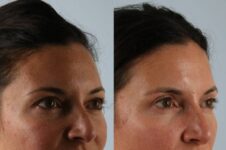Before and After Eyelid Surgery Blepharoplasty Female Patient right angle view case 3539