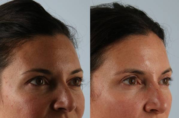 Before and After Eyelid Surgery Blepharoplasty Female Patient right angle view case 3539