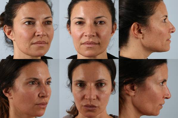 Before and After Eyelid Surgery Blepharoplasty Female Patient multiple angle view case 3539