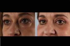Before and After Eyelid Surgery Blepharoplasty Female Patient left angle view case 3544