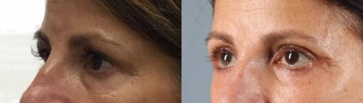 Before and After Eyelid Surgery Female Patient left side Angle View Case 3575