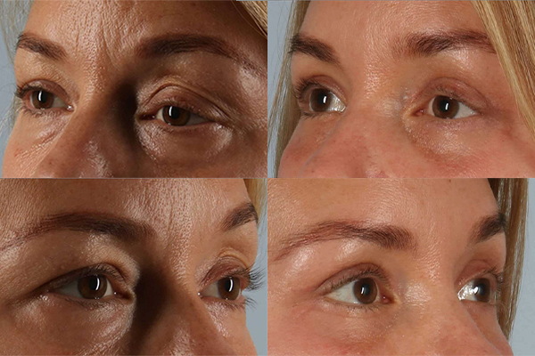 eyelid surgery before and after case 3579