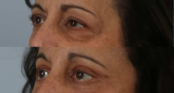eyelid surgery before and after case 3563