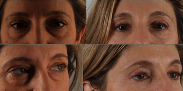 eyelid surgery before and after case 3554