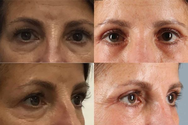 before and after eyelid surgery female patient multiple angles case 3575