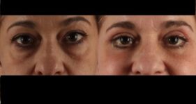 before and after eyelid surgery female patient front view case 3544