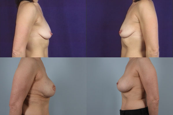 before and after breast reconstruction female patient left and right side view case 3222