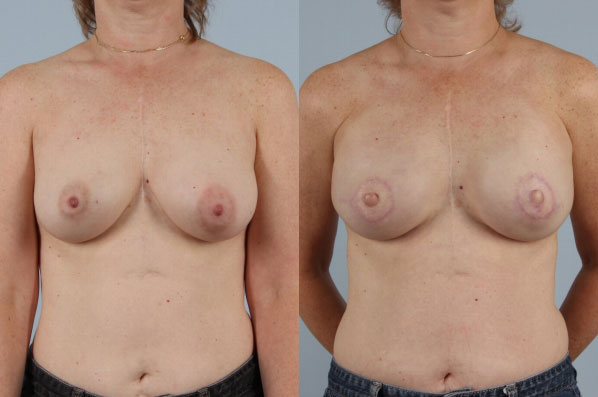 before and after breast reconstruction female patient front view case 3252