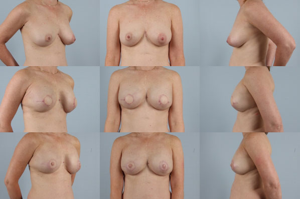 before and after breast reconstruction female patient multiple angle view case 3252