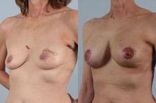 before and after breast reconstruction female patient left diagonal view case 3259