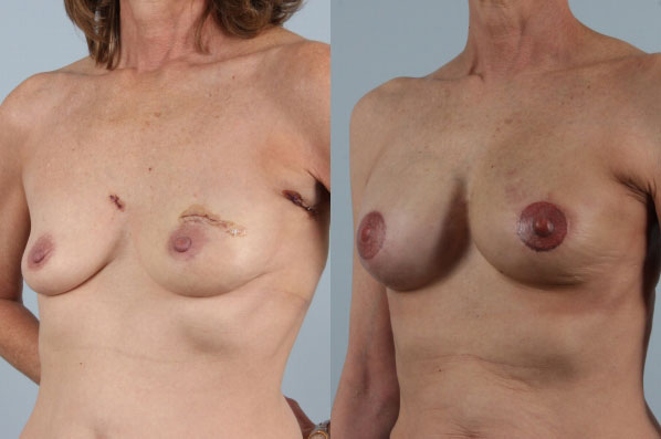 before and after breast reconstruction female patient left diagonal view case 3259