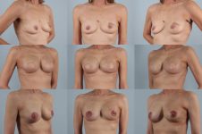 before and after breast reconstruction female patient multiple angle view case 3259