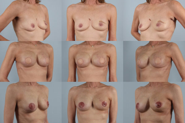 before and after breast reconstruction female patient multiple angle view case 3259
