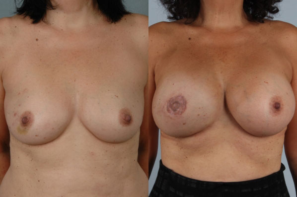 before and after breast reconstruction female patient front view case 3295