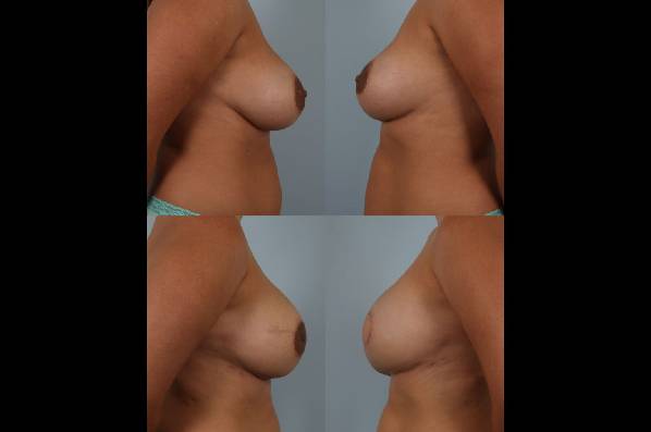 before and after breast reconstruction female patient left and right side view case 3355