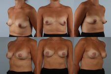 before and after breast reconstruction female patient multiple angle view case 3376