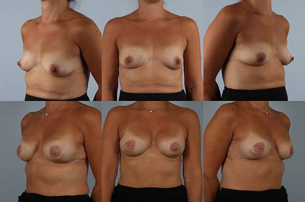before and after breast reconstruction female patient multiple angle view case 3376