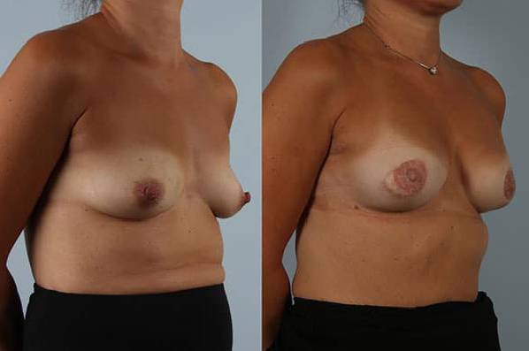 before and after breast reconstruction female patient right diagonal view case 3376