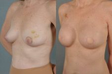 before and after breast reconstruction female patient left diagonal view case 3381