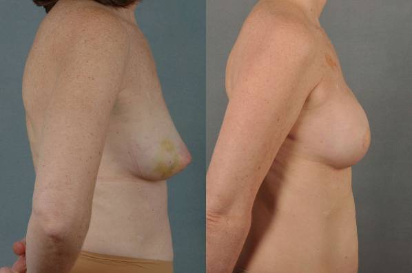 before and after breast reconstruction female patient right side view case 3381