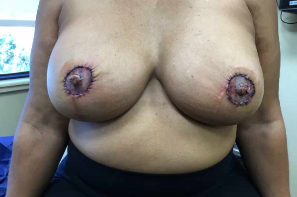 After breast reconstruction after female patient front view case 3385